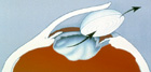 Extracapsular cataract extraction