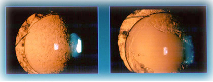 Post Capsulotomy