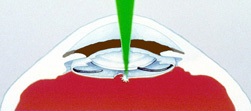 YAG Laser Capsulotomy
