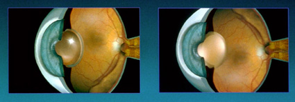 Eye with Cataract